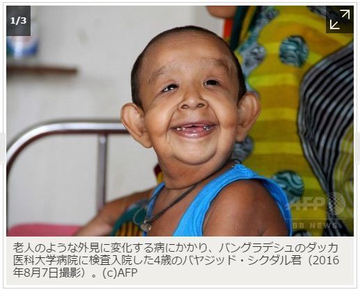 バングラディッシュの奇病 4歳児なのに 外見がまるで老人 ウェルナー症候群 話題のニュースを医学的 科学的視点で分析